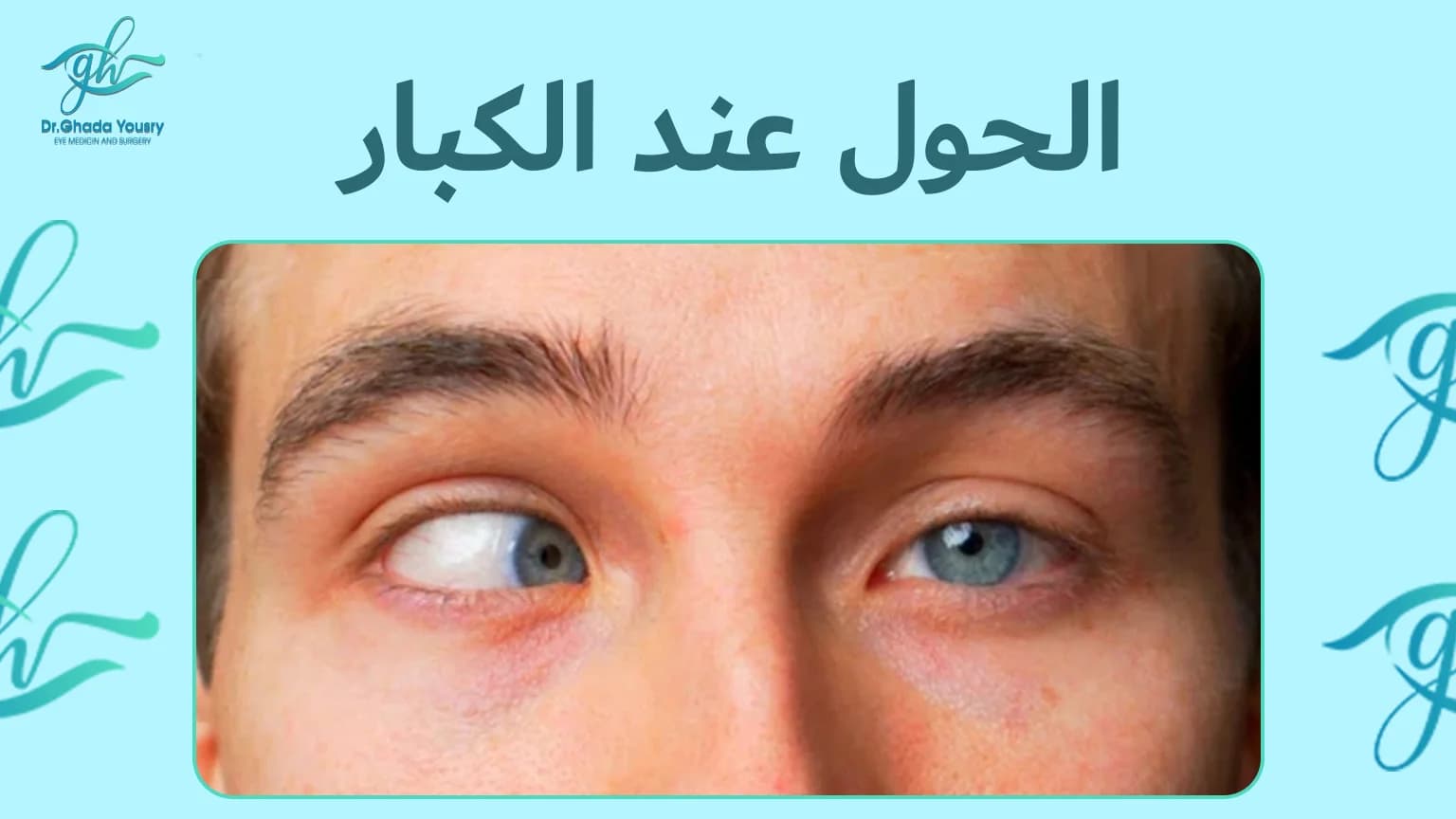 علاج الحول عند الكبار جراحياً وغير جراحياً مع دكتورة غادة