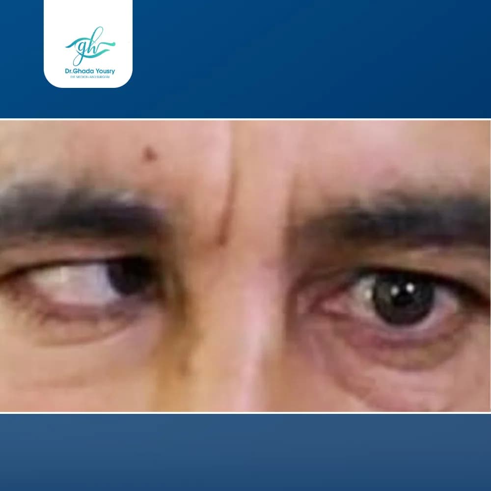Esotropia in adults
