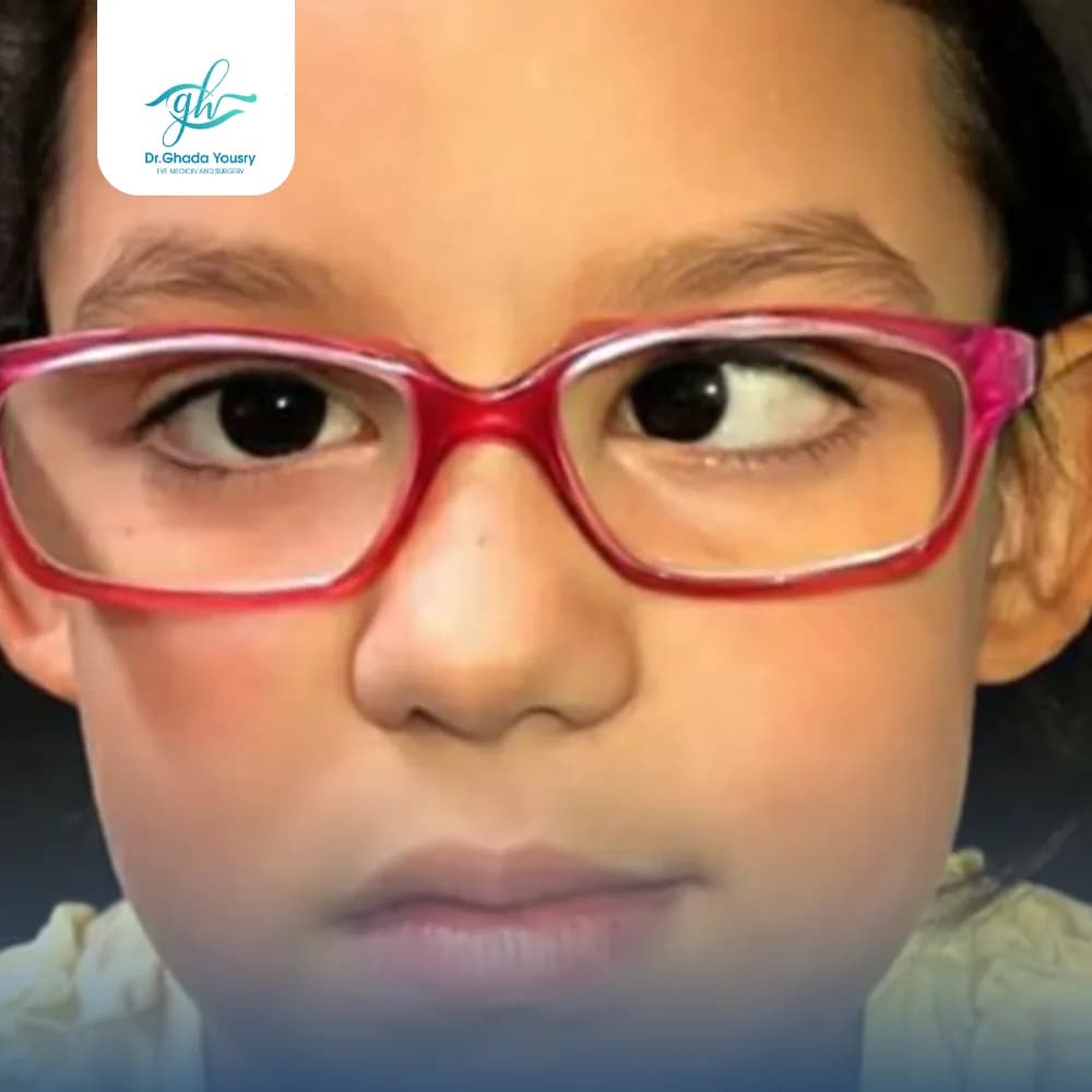 Esotropia in children