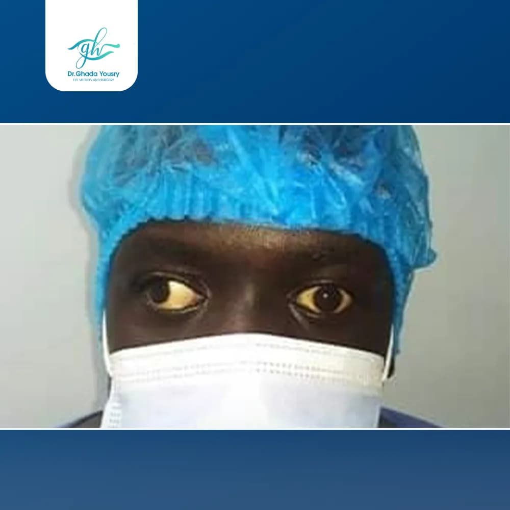 Exotropia in adults