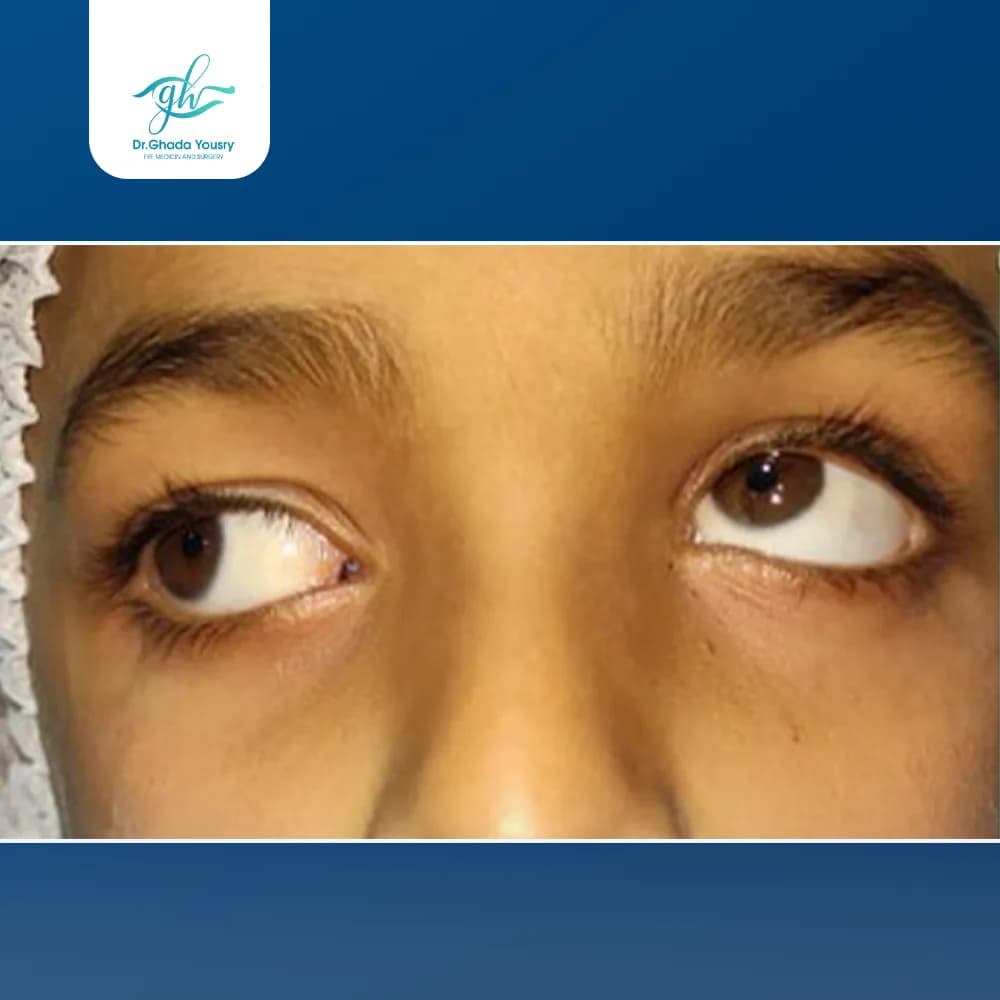 Vertical strabismus