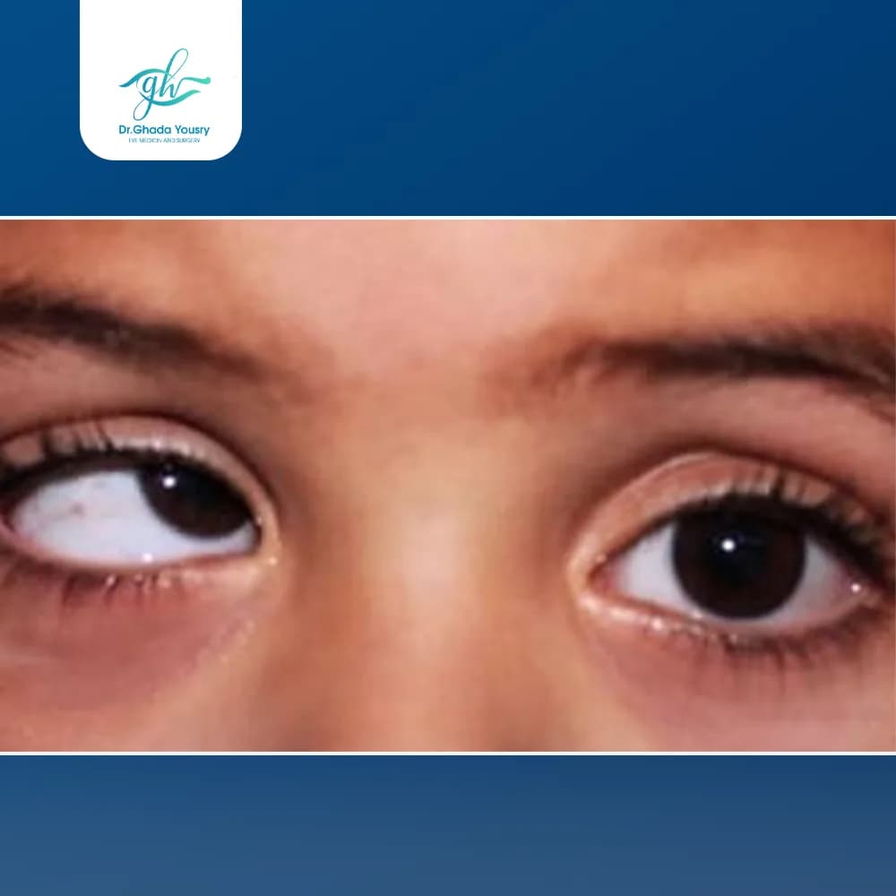 Combined strabismus