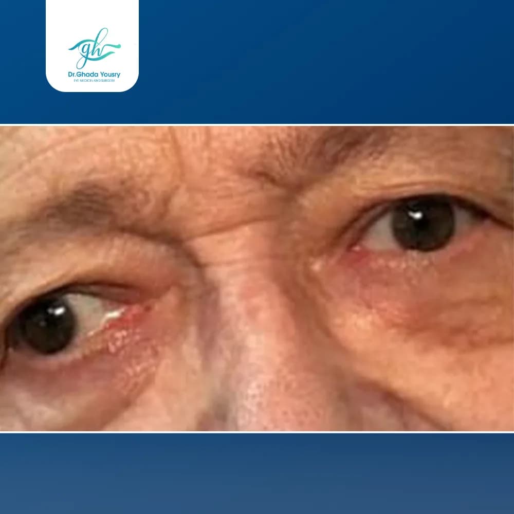 Diabetes-related strabismus