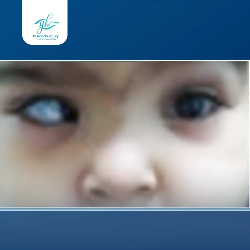 Esotropia requiring surgery
