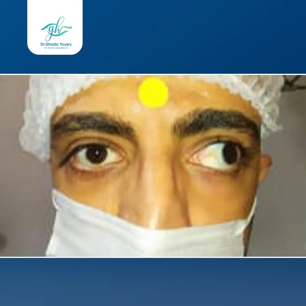Strabismus after retinal detachment surgery