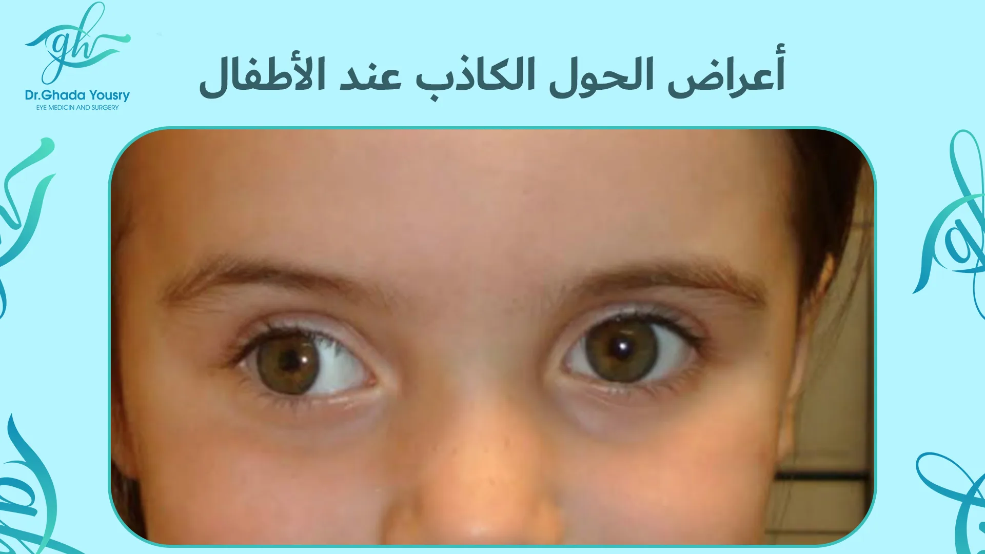 أعراض الحول الكاذب عند الأطفال | الفرق بين الحول الحقيقي والكاذب