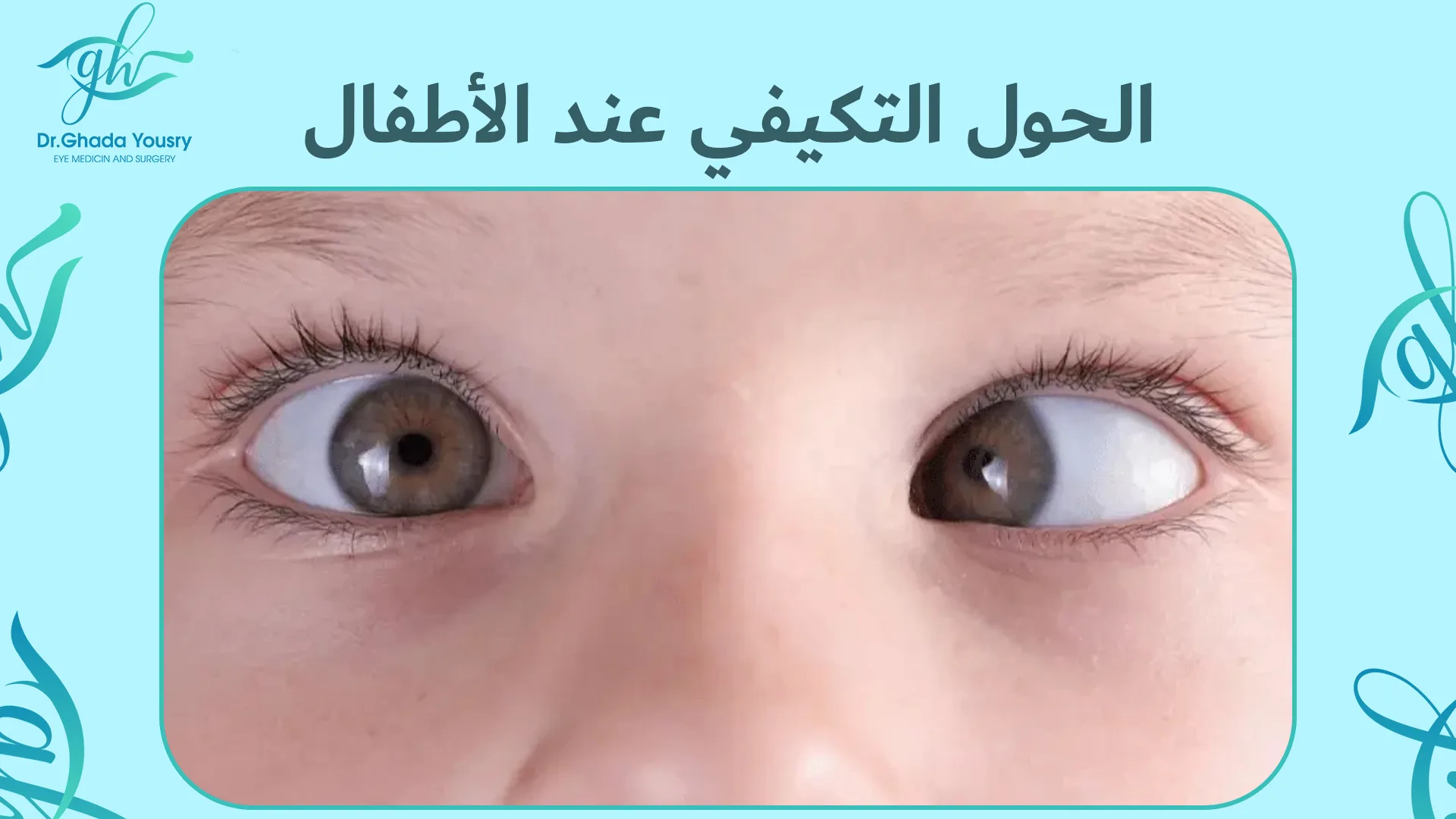 الحول التكيفي عند الأطفال | الأسباب والأعراض وطرق العلاج مع د. غادة يسري