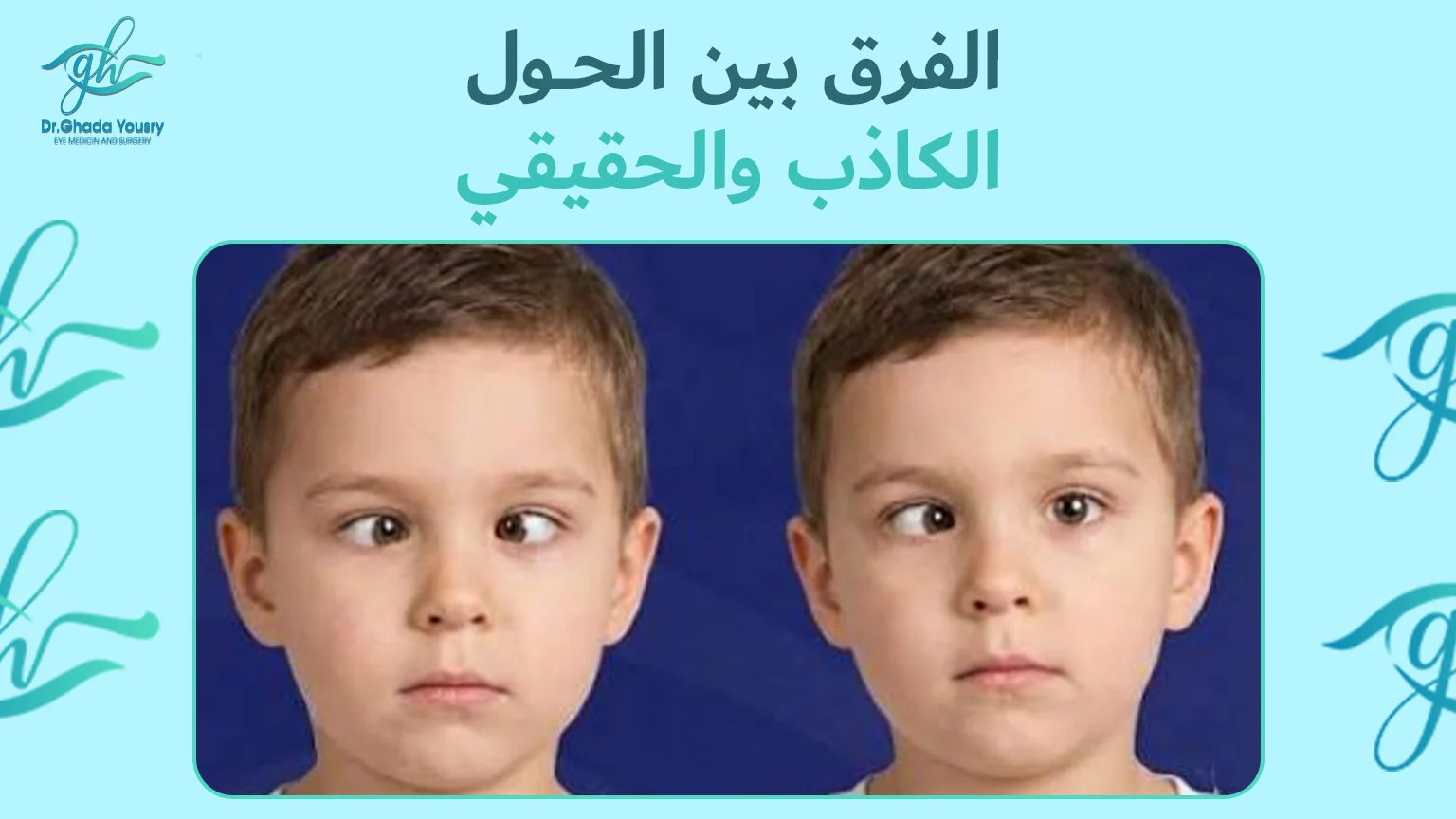 الفرق بين الحول الكاذب والحقيقي وأفضل طرق التشخيص والعلاج