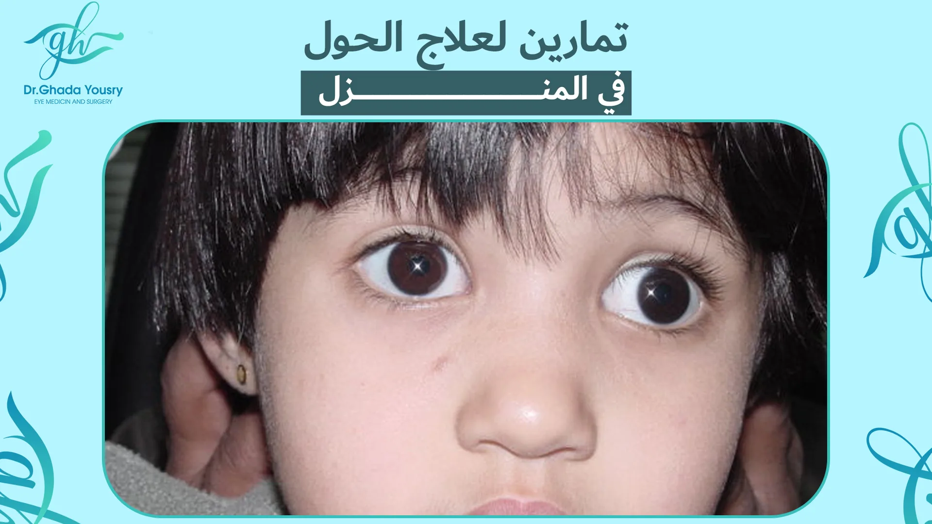 تمارين لعلاج الحول في المنزل | أفضل طرق تقوية عضلات العين