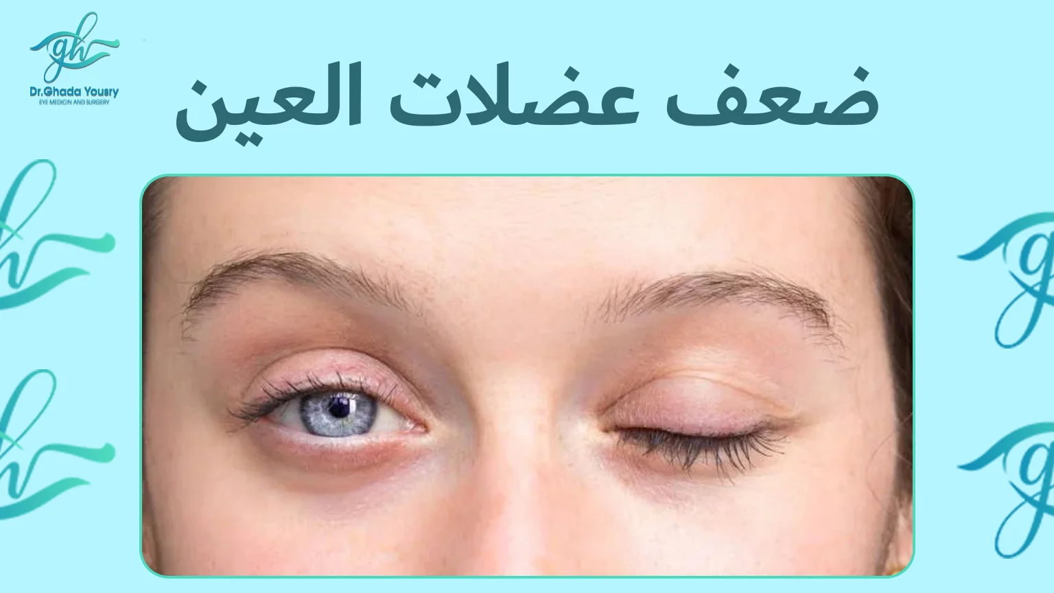 هل ضعف عضلات العين يؤدي إلى الحَوَل؟
