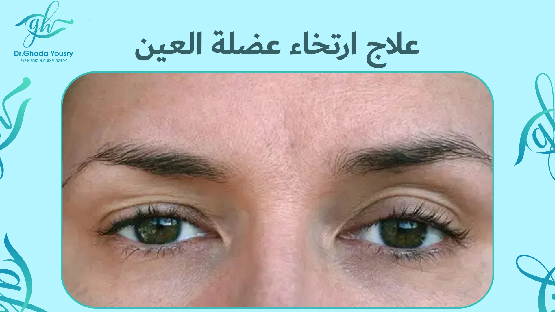 علاج ارتخاء عضلة العين | الأسباب والأعراض وطرق العلاج