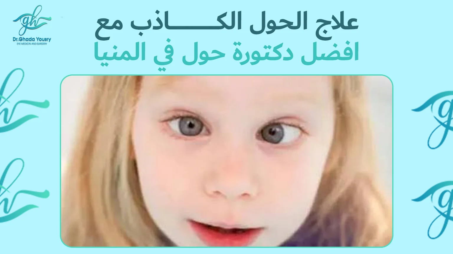 علاج الحول الكاذب مع افضل دكتورة حول في مصر
