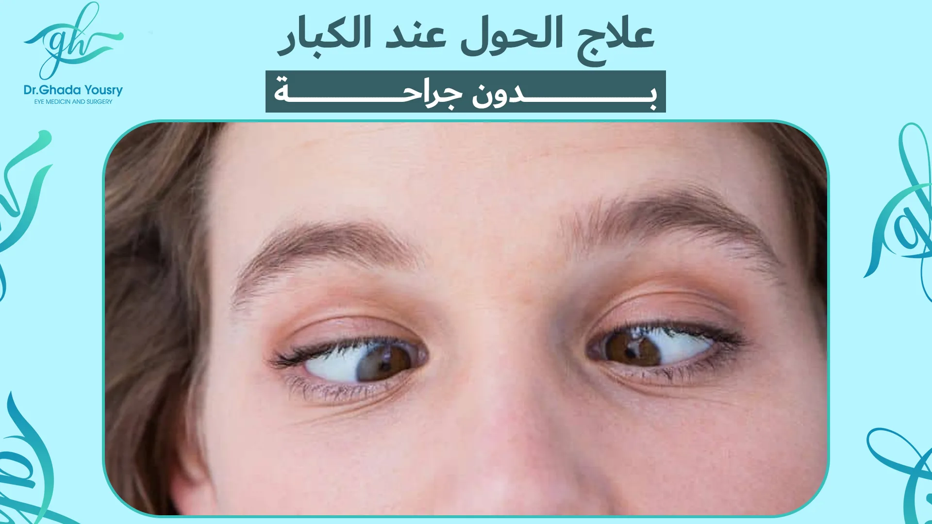 علاج الحول عند الكبار بدون جراحة