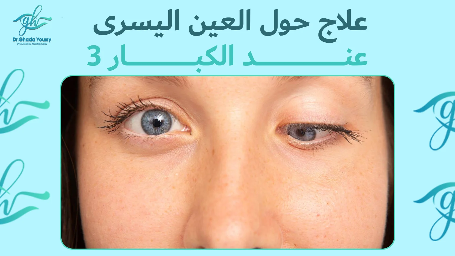 علاج حول العين اليسرى عند الكبار | الأسباب وطرق العلاج