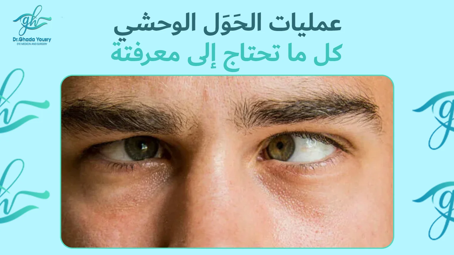 عمليات الحَوَل الوحشي: كل ما تحتاج إلى معرفته مع أفضل دكتورة عيون – د. غادة يسري