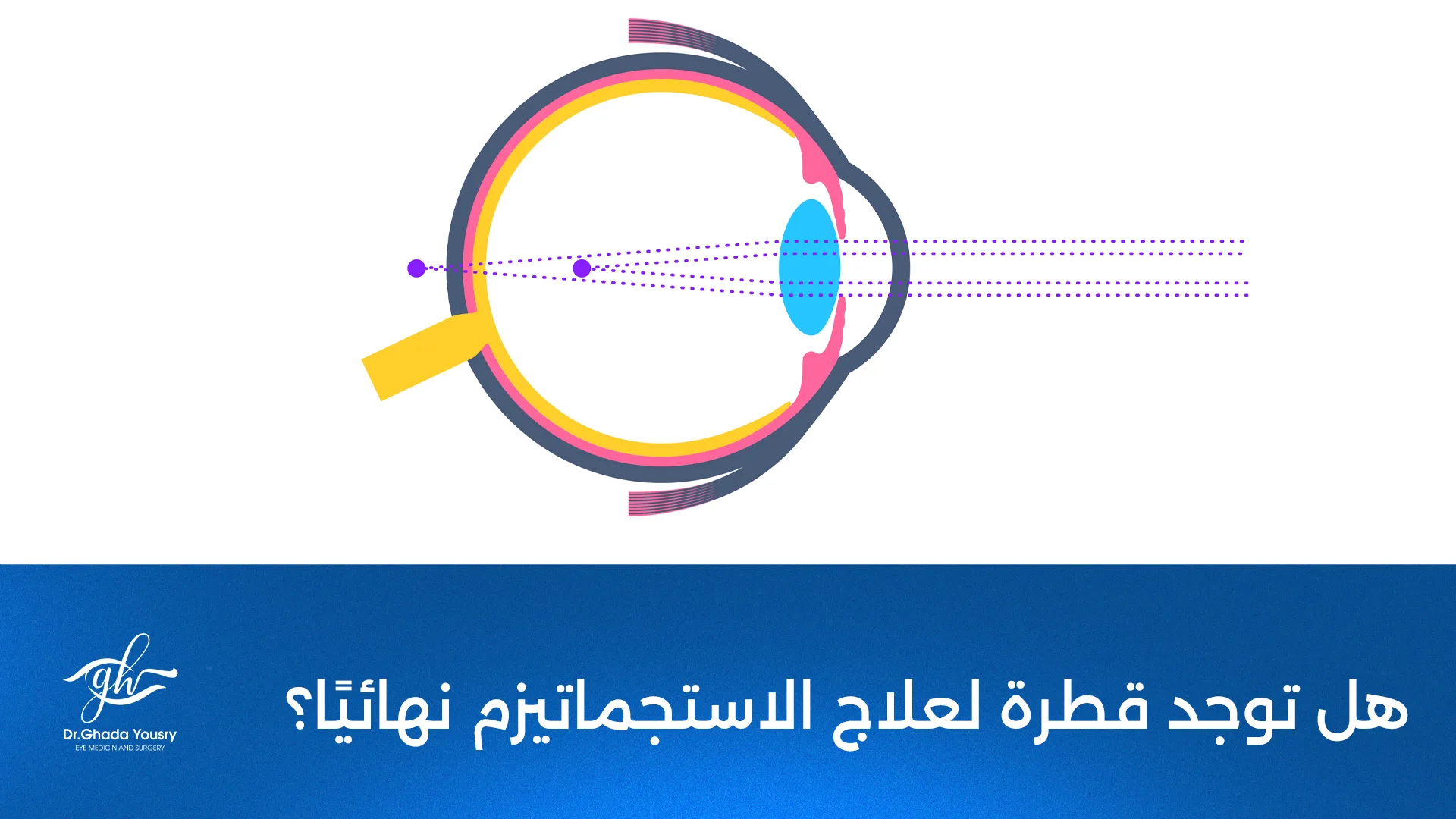 قطرة لعلاج الاستجماتيزم | هل تعالج المشكلة نهائيًا؟