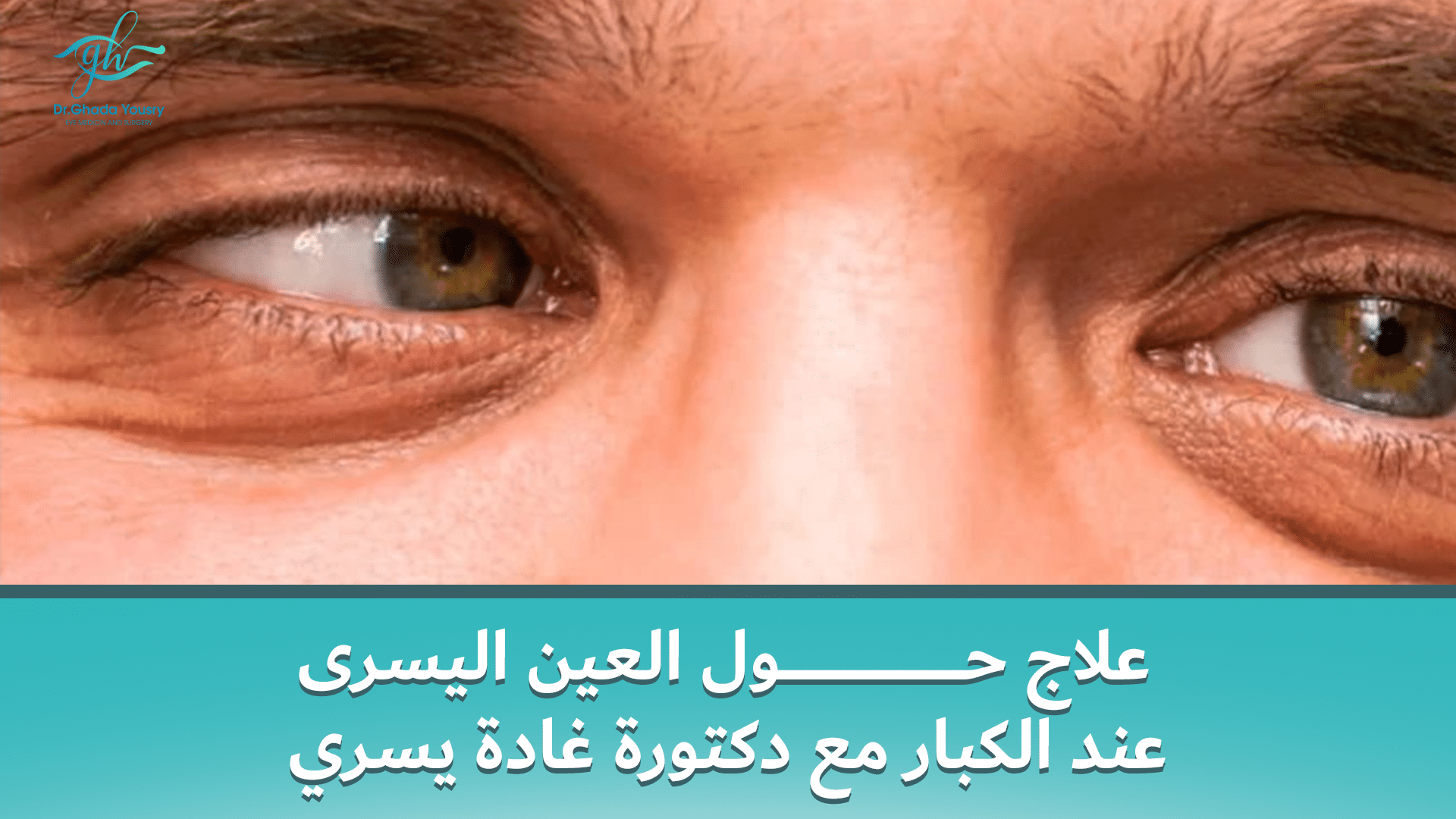 You are currently viewing علاج حول العين اليسرى عند الكبار مع دكتورة غادة يسري