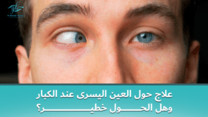 علاج حول العين اليسرى عند الكبار وهل الحول خطير؟