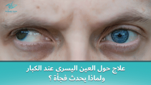 علاج حول العين اليسرى عند الكبار ولماذا يحدث فجأة ؟