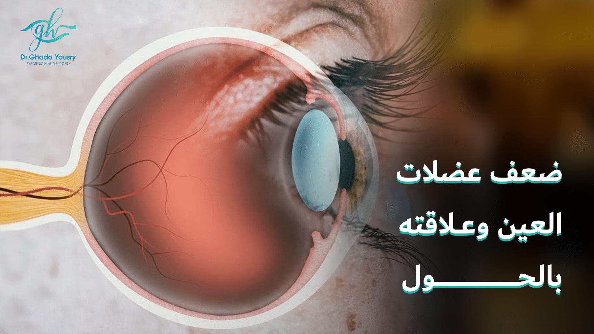 You are currently viewing هل ضعف عضلات العين يؤدي إلى الحَوَل؟
