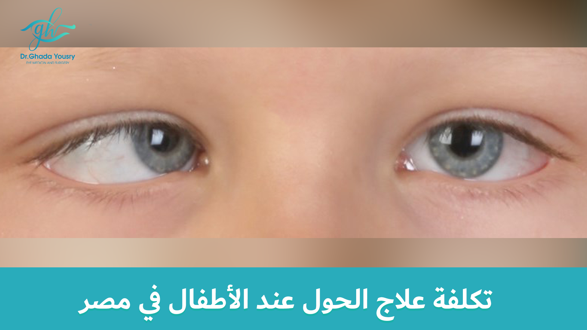 You are currently viewing تكلفة علاج الحول عند الأطفال في مصر: العوامل المؤثرة والتفاصيل الكاملة