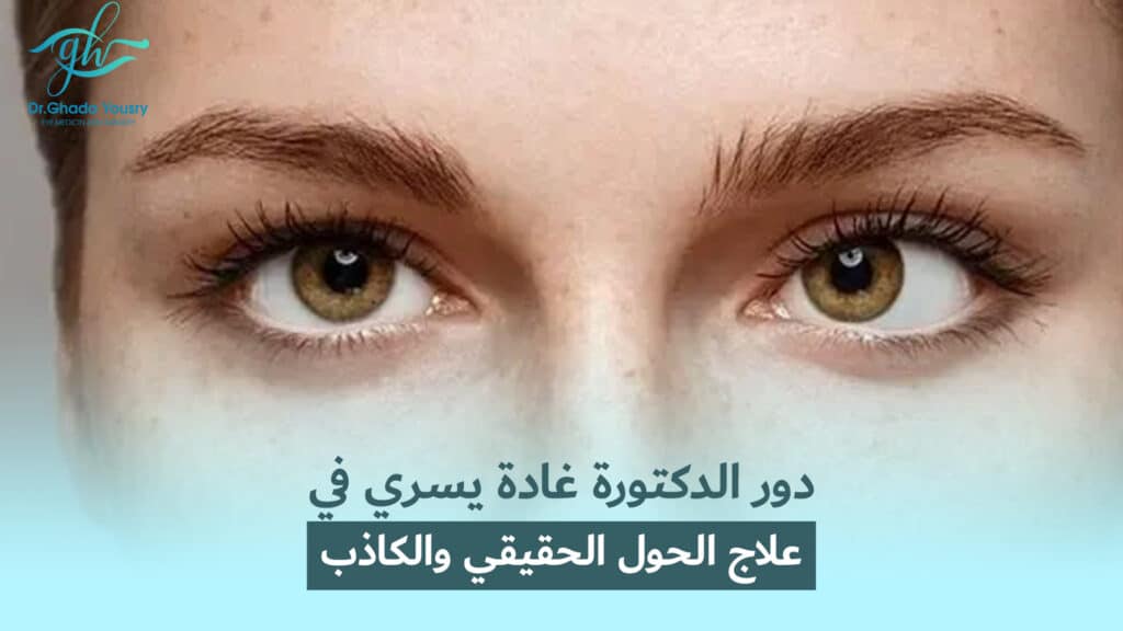 دور الدكتورة غدة يسري في علاج الحول الحقيقي والكاذب