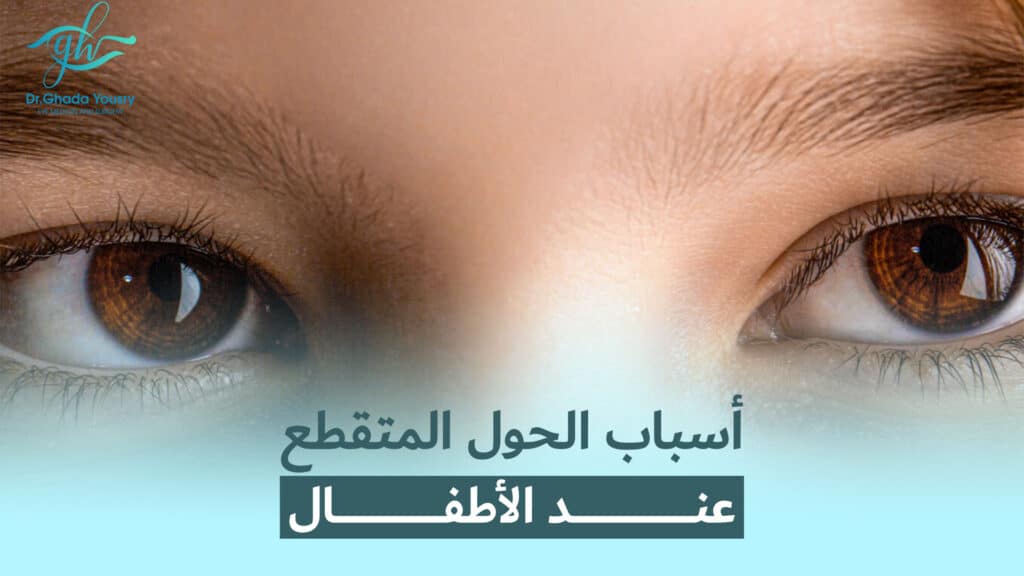 أسباب الحول المتقطع عند الأطفال