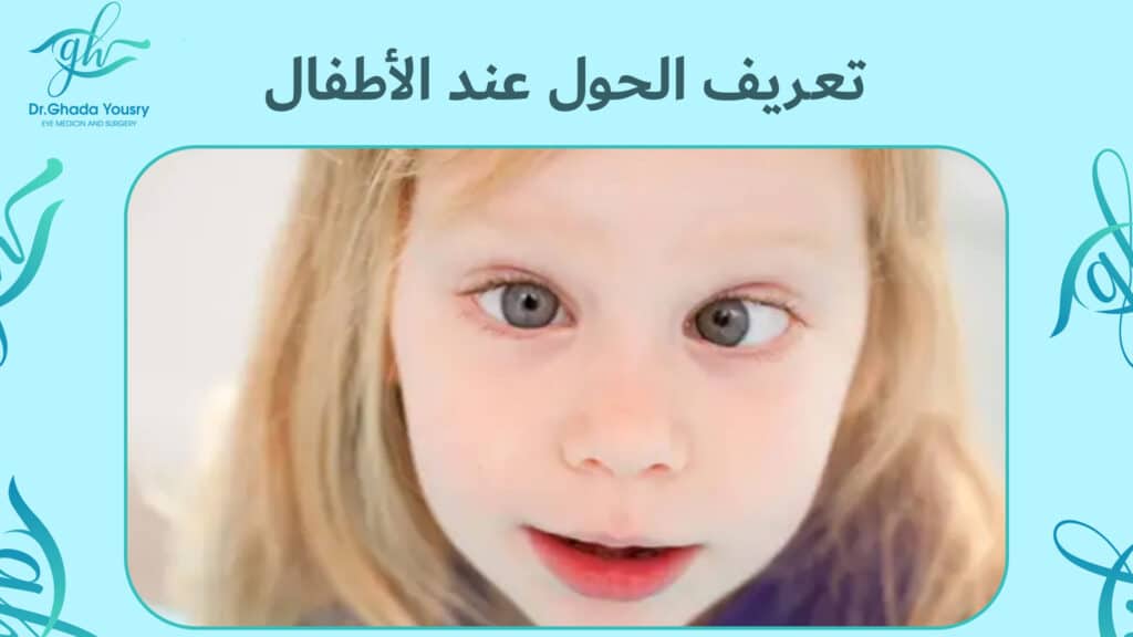 تعريف الحول عند الأطفال