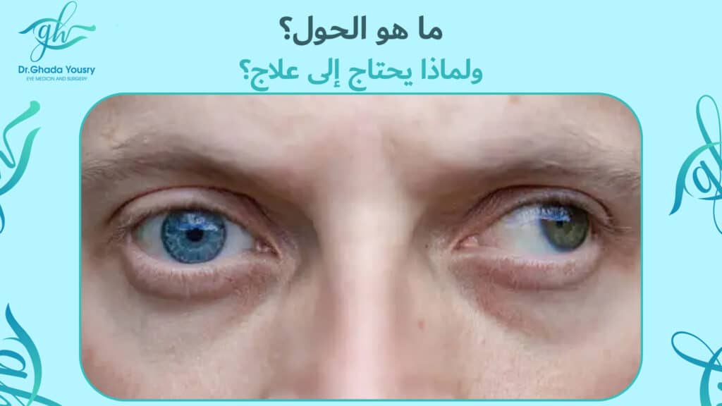 ما هو الحول؟ ولماذا يحتاج إلى علاج؟