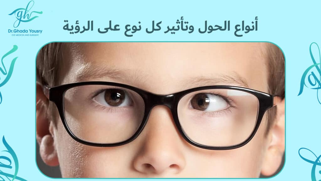 أنواع الحول وتأثير كل نوع على الرؤية