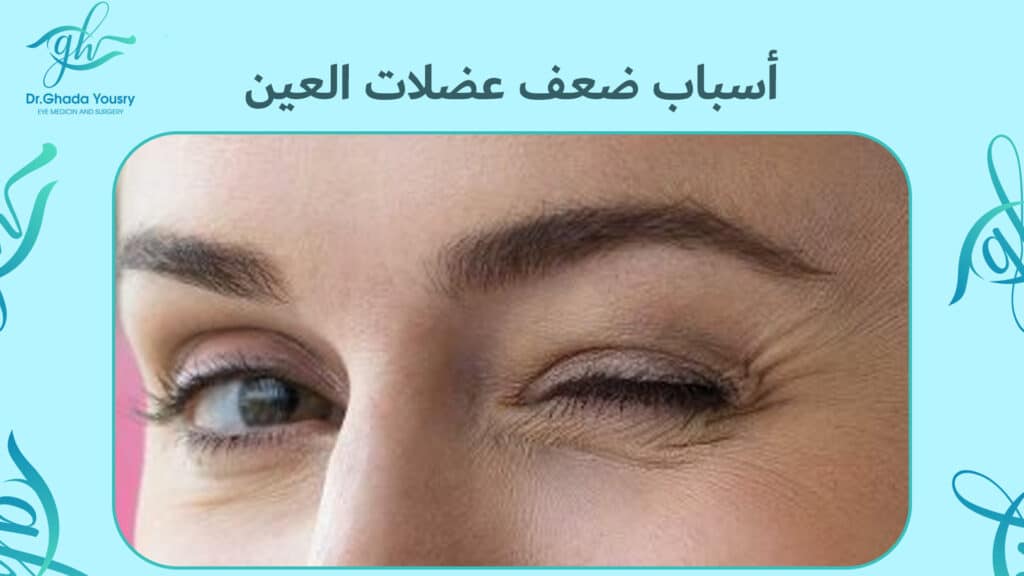 أسباب ضعف عضلات العين